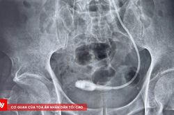 Người đ&agrave;n &ocirc;ng mang ống Sonde JJ trong cơ thể suốt 9 năm