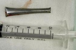 Cán thìa inox 'ẩn náu' trong phế quản người đàn ông