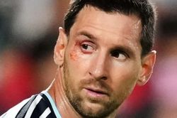 Lý do mắt Messi rướm máu