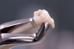Đi nhổ răng khôn, cụ bà 83 tuổi suýt tử vong