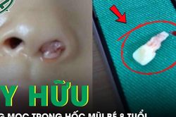 Răng mọc trong hốc mũi bé gái 8 tuổi