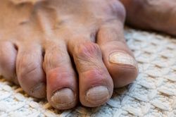 Hạt tophi ở người bệnh gout khi nào cần xử trí?