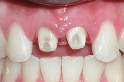 Trước khi mài răng để bọc sứ, đừng quên 4 câu hỏi này