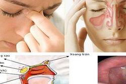 Vi&ecirc;m mũi xoang m&ugrave;a mưa: Đừng chủ quan với những cơn nghẹt mũi k&eacute;o d&agrave;i