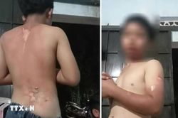 Đắk Lắk: Xác minh thông tin bé trai nghi bị mẹ tạt nước sôi gây bỏng nặng