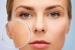 Da mặt bị rỗ có thể cải thiện tại nhà không? Chuyên gia chỉ những cách nên áp dụng