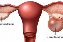 Ph&aacute;t hiện u buồng trứng khổng lồ sau 2 năm bỏ t&aacute;i kh&aacute;m, người phụ nữ 68 tuổi thừa nhận sai lầm nhiều chị em mắc phải