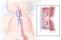 Teo thực quản bẩm sinh cần ph&aacute;t hiện sớm