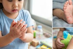 Tay chân miệng ở trẻ em: Những biến chứng cha mẹ không nên chủ quan