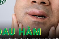 Đau hàm lâu ngày, người đàn ông tá hỏa phát hiện viên sỏi lớn trong tuyến nước bọt