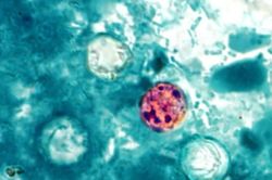 Ký sinh trùng Cyclospora là gì và vì sao đang gây lo ngại tại Mỹ?