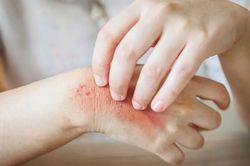 Cách nhận biết và phòng tránh bệnh da thường gặp mùa hè