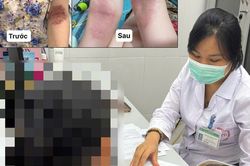 Người phụ nữ thoát cảnh 6 năm quấn khăn quanh người nhờ phác đồ đặc biệt