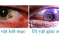 Cảnh b&aacute;o dị vật mắt khi lao động g&acirc;y thủng gi&aacute;c mạc