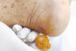 Ngỡ vết thương nhỏ không đáng kể, hai bệnh nhân bất ngờ nguy kịch