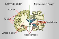 Liệu pháp miễn dịch mở ra hướng điều trị bệnh Alzheimer