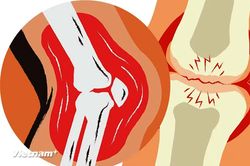 Tìm ra cơ chế gây bệnh ung thư xương hiếm gặp