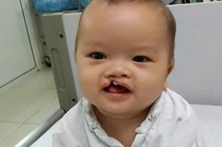 MS 1099: Bé trai 8 tháng tuổi bị bỏ rơi trước cổng chùa cần trợ giúp để phẫu thuật dị tật