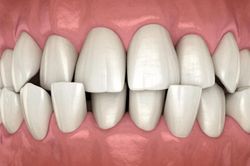 10 dấu hiệu cần chỉnh nha sớm ở trẻ em, đừng đợi đến khi con mọc đủ răng mới đi khám