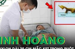 Kinh hoàng: Túi nilon dài 20 cm mắc kẹt trong ruột bệnh nhân
