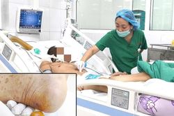 Gà mổ vào gót chân khiến cụ ông nguy kịch