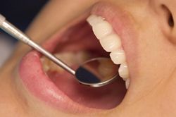 Vi khuẩn thường gặp trong miệng có thể là 'thủ phạm' âm thầm gây hẹp van tim?