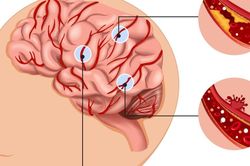 Những yếu tố làm tăng nguy cơ xuất huyết não
