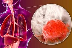 Thói quen ăn uống âm thầm 'nuôi dưỡng' ung thư thực quản