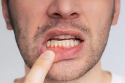 Kẹo dẻo lợi khuẩn giúp giảm chảy máu chân răng chỉ sau 6 tuần
