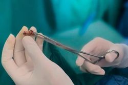 Sai lầm khi chữa trĩ, người đàn ông gánh hậu quả đau đớn