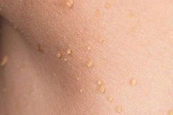 Vì sao mụn thịt thường mọc quanh mắt, xử trí thế nào?