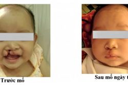 Nghệ An tiếp nhận viện trợ chăm sóc trẻ em bị dị tật khe hở môi, vòm miệng