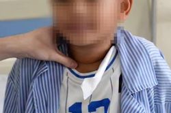 Bé 8 tuổi mắc ung thư tuyến giáp từ dấu hiệu rất dễ bị bỏ qua