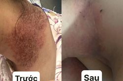 Khổ sở quấn khăn quanh người nhiều năm vì căn bệnh da liễu hiếm gặp