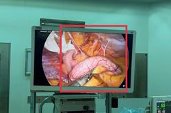 Đau bụng nhẹ hai ngày, nhập viện bác sĩ phát hiện ruột thừa viêm nặng