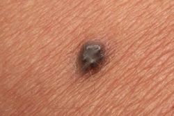 Người đàn ông 69 tuổi nguy kịch từ nốt ruồi 'lạ', bác sĩ chỉ mặt điểm tên dấu hiệu 'chí mạng' nhiều người bỏ qua