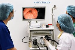 Gắp xương cá cắm sâu trong dạ dày bệnh nhân 70 tuổi