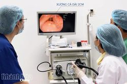 Bệnh viện 22-12 kịp thời gắp dị vật xương cá cắm vào dạ dày bệnh nhân