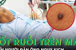 Người đàn ông nguy kịch từ nốt ruồi nhỏ, bác sĩ chỉ mặt dấu hiệu 'chí mạng' nhiều người bỏ qua