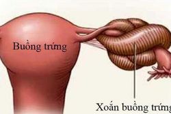 Đau bụng dữ dội, buồn n&ocirc;n ph&aacute;t hiện xoắn u nang buồng trứng