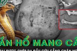 Bé trai thoát cảnh cắt cụt chân nhờ ghép da đầu sau khi bị rắn hổ mang cắn