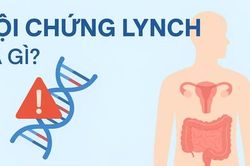 Phát hiện sớm hội chứng Lynch để ngăn ngừa ung thư