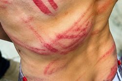 Quên cặp sách, cha đánh con 9 tuổi bầm tím thân thể