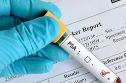 Nam giới từ 40 tuổi cần làm một xét nghiệm để sàng lọc ung thư tuyến tiền liệt
