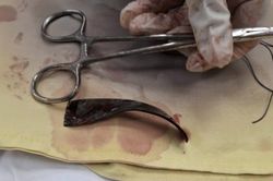 Cứu sống nạn nhân bị lưỡi dao máy cắt cỏ gãy văng trúng bụng đâm thủng ruột, dạ dày