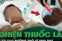 Người đàn ông phải tái tạo đường thở vì ung thư sau 30 năm nghiện thuốc lào