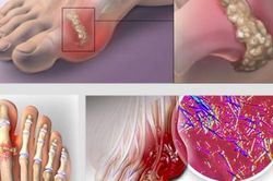 Bị bệnh gout có nên ăn cá?