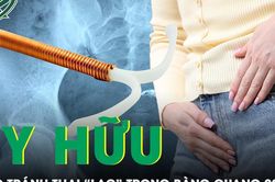 Vòng tránh thai 'mất tích' 29 năm bất ngờ được tìm thấy trong bàng quang