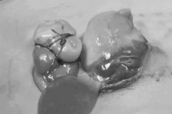 Em bé chào đời với một phần trái tim nằm ngoài cơ thể