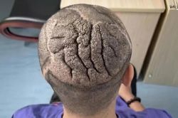 Căn bệnh lạ khiến da đầu chàng trai Trung Quốc trông như não người